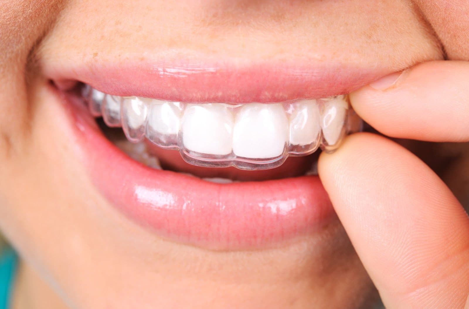 Patient photo from a Google review at Sandhu Dentistry