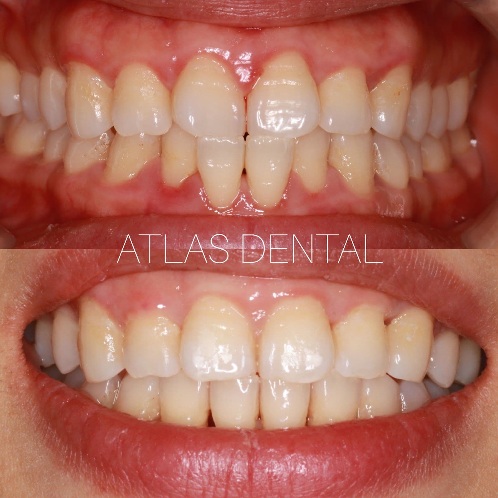 Another patient photo from a Google review at Atlas Dental