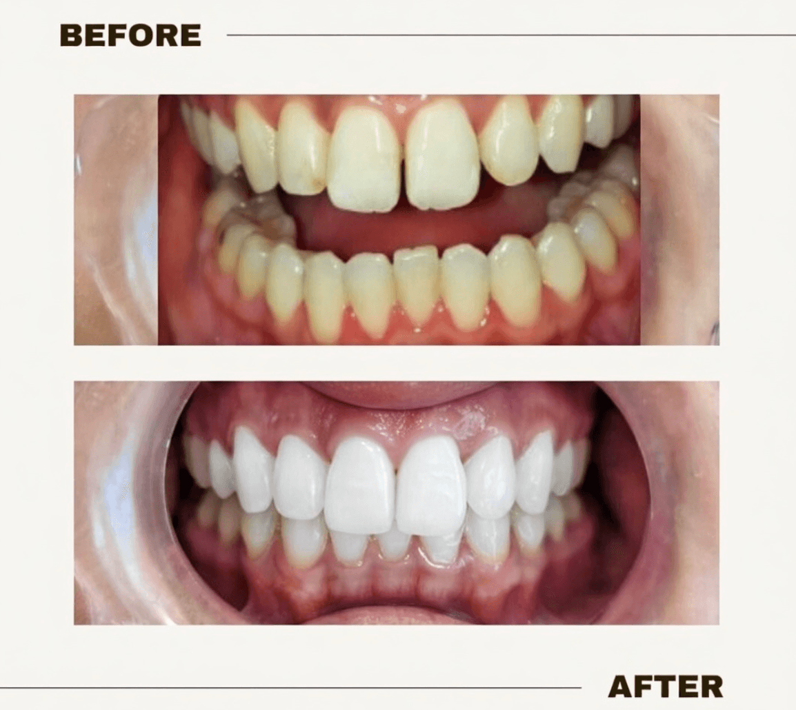 Another patient photo from a Google review at Harbour Dental Centre